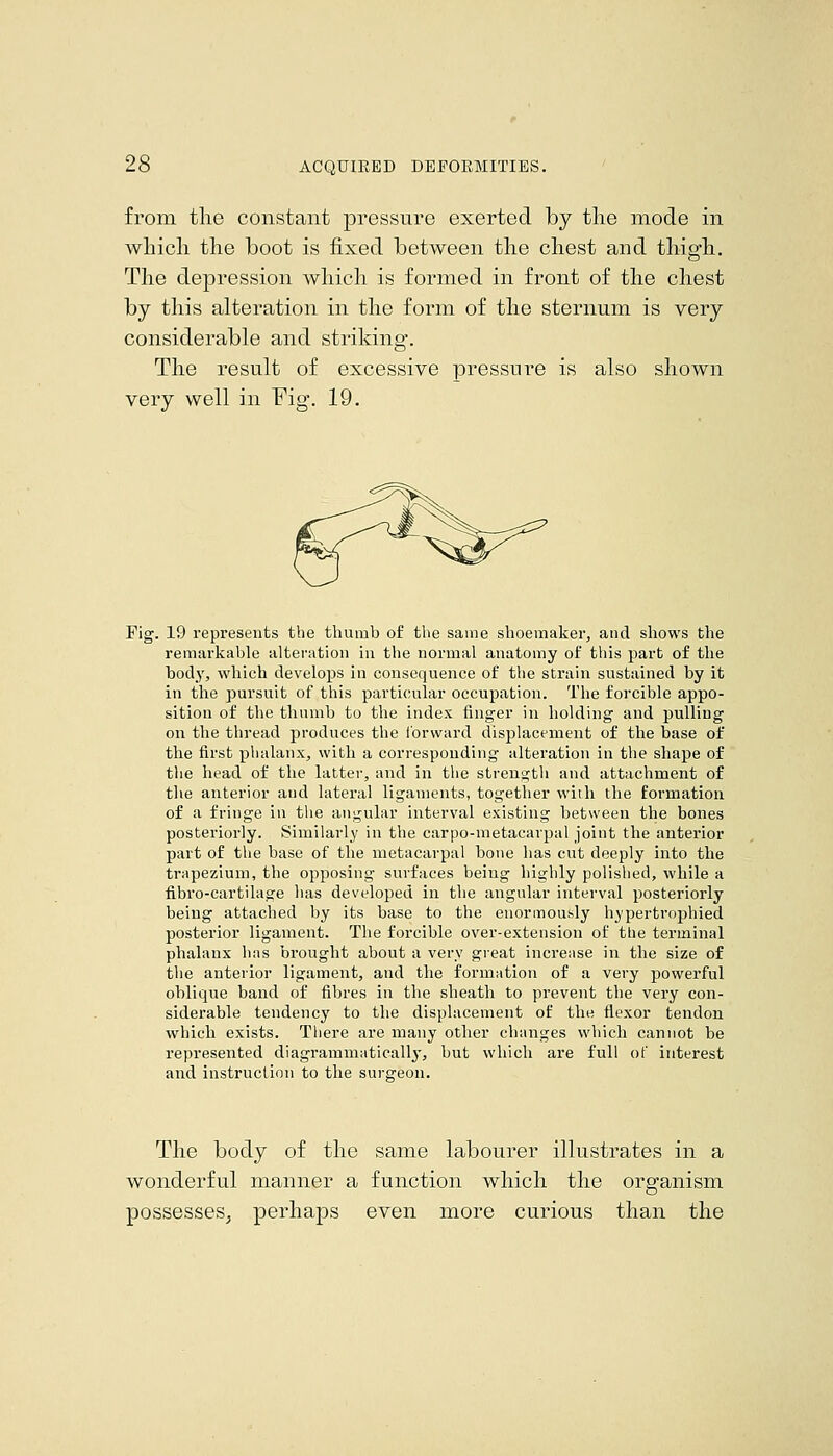 from the constant pressure exerted by the mode in which the boot is fixed between the chest and thigh. The depression which is formed in front of the chest by this alteration in the form of the sternum is very considerable and striking. The result of excessive pressure is also shown very well in Fig. 19. Fig. 19 represents the thumb of the same shoemaker, and shows the remarkable alteration in the normal anatomy of this part of the body, which develops in consequence of the strain sustained by it in the pursuit of this particular occupation. The forcible appo- sition of the thumb to the index finger in holding and pulling on the thread produces the Ibrward displacement of the base of the first plialanx, with a corresponding alteration in the shape of the head of the latter, and in the streugtli and attachment of the anterior and lateral ligaments, together with the formation of a fringe in the anguLir interval existing between the bones posteriorly. Similarly in the carpo-metacarpal joint the anterior part of the base of the metacarpal bone has cut deeply into the trapezium, the opposing surfaces being highly polished, while a fibro-cartilage has developed in the angular interval posteriorly being attached by its base to the enormously hjpertrophied posterior ligament. The forcible over-extension of the terminal phalanx has brought about a very great increase in the size of the anterior ligament, and the formation of a very powerful oblique band of fibres in the sheath to prevent the very con- siderable tendency to the displacement of the flexor tendon which exists. There are many other changes which cannot be represented diagrammatically, but which are full of interest and instruction to the surgeon. The body of the same labourer illustrates in a wonderful manner a function which the organism possesses, perhaps even more curious than the