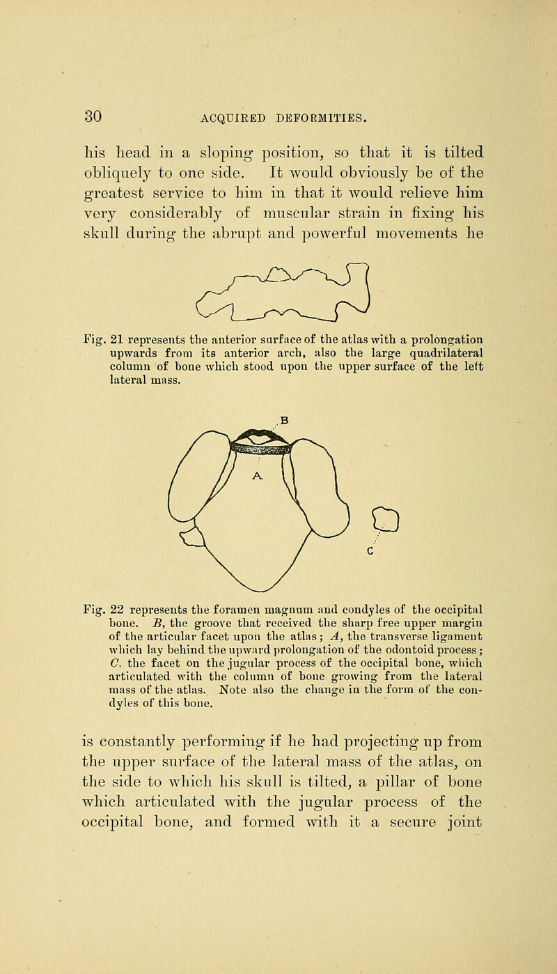liis head in a sloping position, so that it is tilted obliquely to one side. It would obviously be of the greatest service to him in that it would relieve him very considerably of muscular strain in fixing his skull during the abrupt and powerful movements he Fig. 21 represents the anterior surface of the atlas with a prolongation upwards from its anterior arch, also the large quadrilateral column of bone which stood upon the upper surface of the left lateral mass. o Fig. 22 represents the foramen magnum and condyles of the occipital bone. -B, the groove that received the sharp free upper margin of the articular facet upon the atlas; A, the transverse ligament which lay behind the upward prolongation of the odontoid process; C, the facet on the jugular process of the occipital bone, wliich articulated with the column of bone growing from the lateral mass of the atlas. Note also the change in the form of the con- dyles of this bone. is constantly performing if he had projecting up from the upper surface of the lateral mass of the atlas, on the side to which his skull is tilted, a pillar of bone which articulated with the jugular process of the occipital bone, and formed with it a secure joint