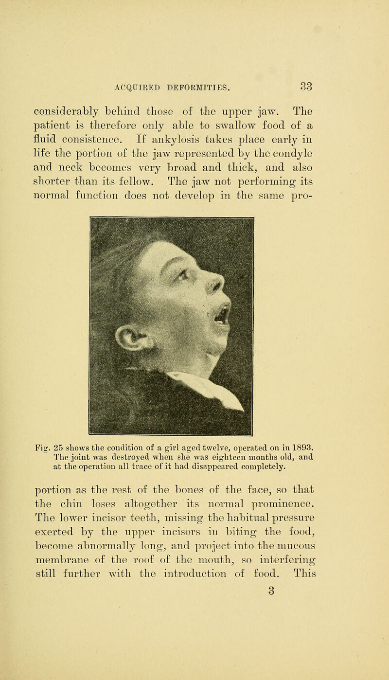 considerably behind those of the upper jaw. The patient is therefore only able to swallow food of a fluid consistence. If ankylosis takes place early in life the portion of the jaw represented by the condyle and neck becomes very broad and thick^ and also shorter than its fellow. The jaw not performing its normal function does not develop in the same pro- Fig. 25 shows the condition of a girl aged twelve, operated on in 1893. The joint was destroyed when she was eighteen months old, and at the operation all trace of it had disappeared completely. portion as the rest of the bones of the face^ so that the chin loses altogether its normal prominence. The lower incisor teeth, missing the habitual pressure exerted by the upper incisors in biting the food, become abnormally long, and project into the mucous membrane of the roof of the mouth, so interfering still further with the introduction of food. This