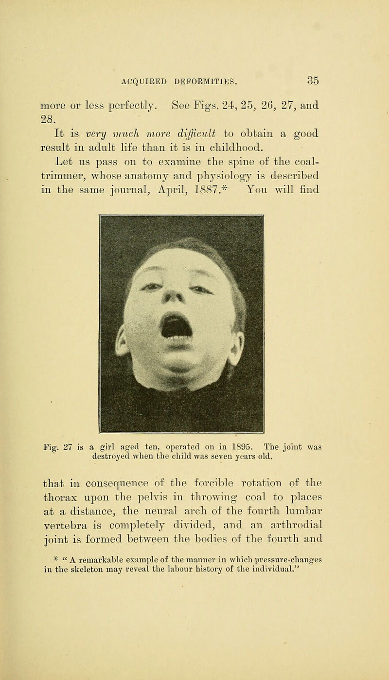 more or less perfectly. See Figs. 24, 25^ 26, 27, and 28. It is very inuch more difficult to obtain a good result in adult life than it is in cliildhood. Let us pass on to examine the spine of the coal- trimmer, whose anatomy and physiology is described in the same journal, April, 1887.^ You will find Fig. 27 is a girl aged ten, operated on in 1895. The joint was destroyed when the child was seven years old. that in consequence of the forcible rotation of the thorax upon the pelvis in throwing coal to places at a distance, the neural arch of the fourth lumbar vertebra is completely divided, and an arthrodial joint is formed between the bodies of the fourth and *  A remarkable example of the manner in which pressure-changes ia the skeleton may reveal the labour histoi-y of the individual.