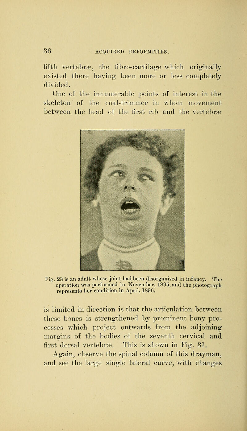 fiftli vertebrae^ tlie fibro-cartilage wliicli originally existed there having been more or less completely divided. One of the innumerable points of interest in the skeleton of the coal-trimmer in whom movement between the head of the first rib and the vertebrae Fig. 28 is an adult whose joint had been disorganised in infancj'. The operation was performed in November, 1895, and the photograph represents her condition in April, 1896. is limited in direction is that the articulation between these bones is strengthened by prominent bony pro- cesses which project outwards from the adjoining margins of the bodies of the seventh cervical and first dorsal vertebree. This is shown in Fig. 31. Again^ observe the spinal column of this drayman^ and see the large single lateral curve, with changes