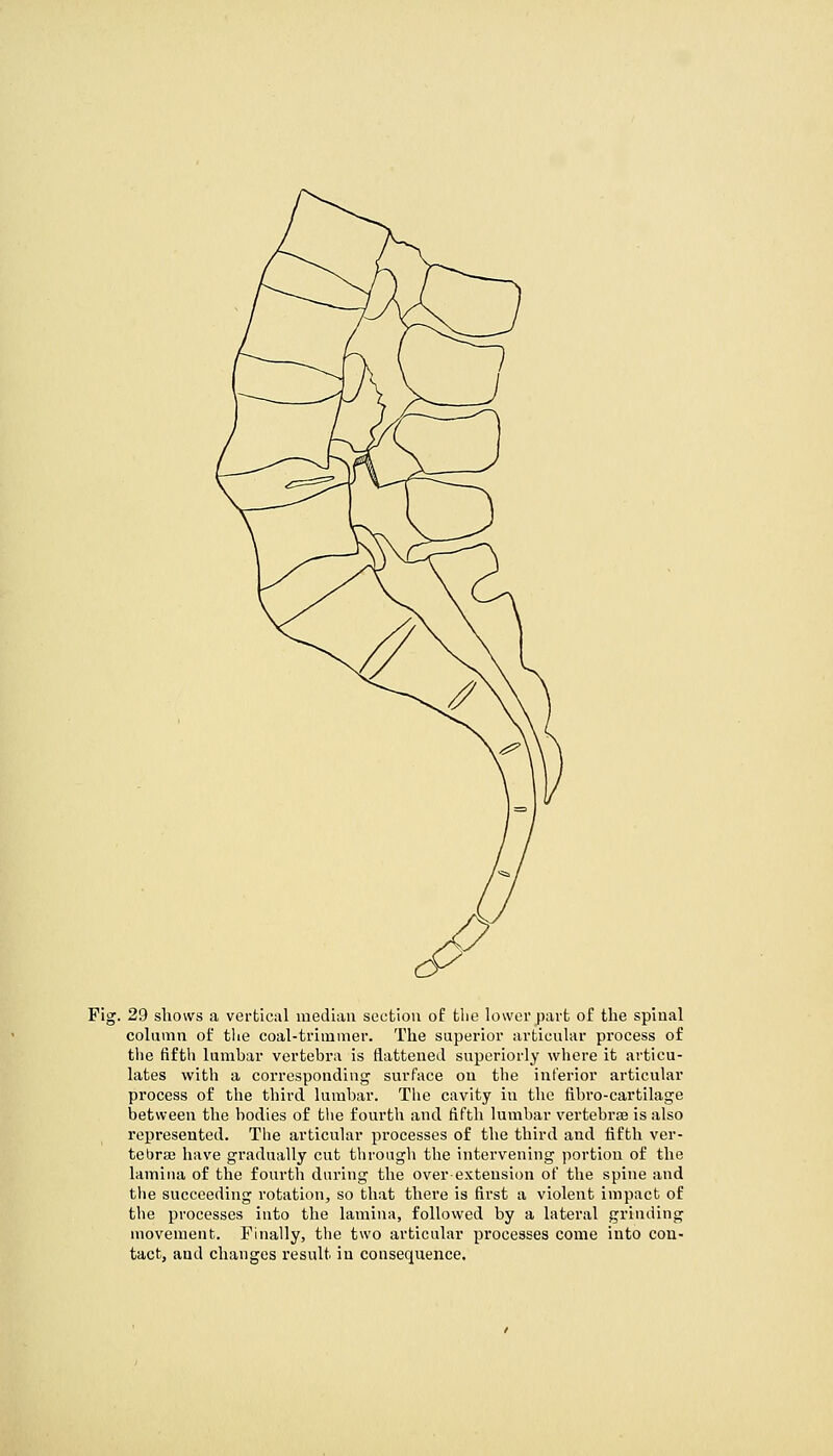 column of the coal-trimmer. The superior articular process of the fiftli lumbar vertebra is flattened superiorly where it articu- lates with a corresponding surface on the inferior articular process of the third lumbar. The cavity in the fibro-cartilage between the bodies of the fourth and fifth lumbar vertebrse is also represented. The articular processes of the third and fifth ver- tebrse have gradually cut through the intervening portion of the lamina of the fourth during the over extension of the spine and the succeeding rotation, so that there is first a violent impact of the processes into the lamina, followed by a lateral grinding movement. Finally, the two articular processes come into con- tact, and changes result in consequence.