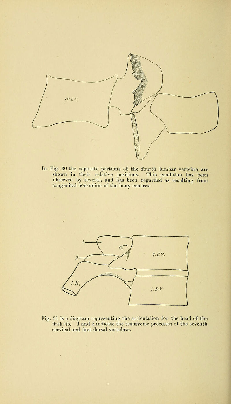 In Fig. 30 the separate portions of the fourth lumbar vertebra are shown in their relative positions. This condition has been observed by several, and has been regarded as resulting from congenital non-union of the bony centres. Fig. 31 is a diagram representing the articulation for the head of the first rib. 1 and 2 indicate the transverse processes of the seventh cervical and first dorsal vertebrae.