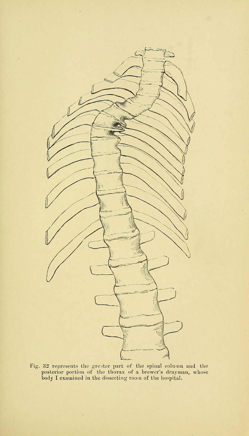 posterior portion of the thorax of a brewer's drayman, whose body I examined in tlie dissecting room of tlie hospital.