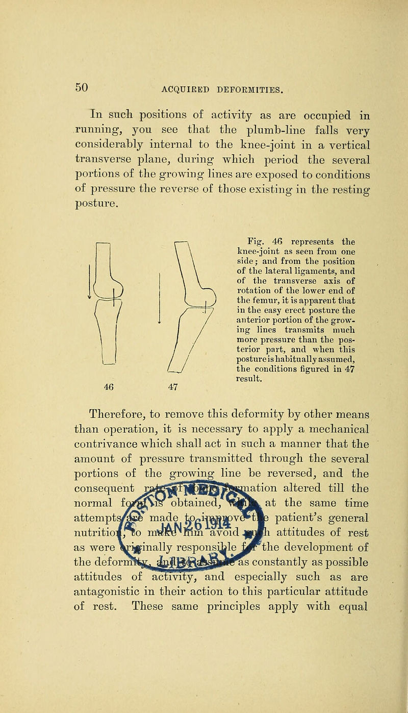 In snch positions of activity as are occupied in running, you see that the plumb-line falls very considerably internal to the knee-joint in a vertical transverse plane, during which period the several portions of the growing lines are exposed to conditions of pressure the reverse of those existing in the resting posture. 46 47 Fig. 46 represents the knee-joint as seen from one side; and from the position of the lateral ligaments, and of the transverse axis of rotation of the lower end of the femur, it is apparent that in the easy erect posture the anterior portion of the grow- ing lines ti-ansmits much more pressure than the pos- terior part, and when this posture is hahitually assumed, the conditions figured in 47 result. Therefore, to remove this deformity by other means than operation, it is necessary to apply a mechanical contrivance which shall act in such a manner that the amount of pressure transmitted through the several portions of the growing line be reversed, and the consequent i;3^^i|l:j||)||^|i5Jsmation altered till the normal foji^^Sis obtained, v^CT^at the same time attempt^e^ made kO/^iiftS^PV^tlp patient^s general nutritiom,nKo my^g^mm avoid ||imli attitudes of rest as were ^i^inally responsible^^^the development of the deforimte^dlQJ&B'R^JiaMP^'S constantly as possible attitudes of activity, and especially such as are antagonistic in their action to this particular attitude of rest. These same principles apply with equal 4