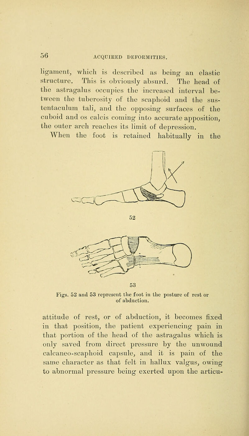 ligament,, wliicli is described as being an elastic structure. This is obviously absurd. Tlie head o£ the astragalus occupies the increased interval be- tween the tuberosity of the scaphoid and the sus- tentaculum tali^ and the opposing surfaces of the cuboid and os calcis coming into accurate apposition, the outer arch reaches its limit of depression. When the foot is retained habitually in the c::^Ca' 52 53 Figs. 52 and 53 represent the foot in the posture of rest or of abduction. attitude of rest, or of abduction, it becomes fixed in that position, the patient experiencing pain in that portion of the head of the astragalus which is only saved from direct pressure by the unwound calcaneo-scaphoid capsule, and it is pain of the same character as that felt in hallux valgus, owing to abnormal pressure being exerted upon the articu-
