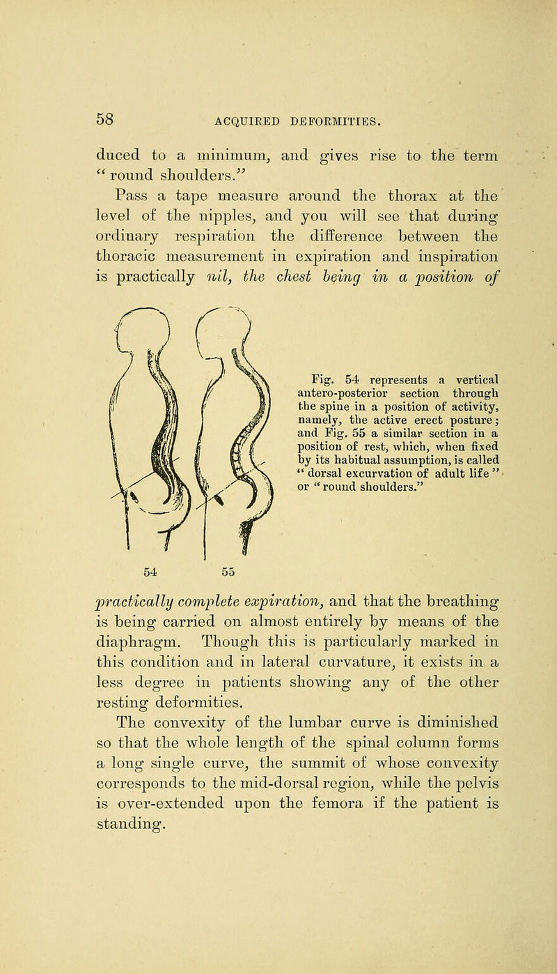 duced to a minimum, and gives rise to the term  round shoulders/^ Pass a tape measure around tlie thorax at the level of the nipples, and you will see that during ordinary respiration the difference between the thoracic measurement in expiration and inspiration is practically nil, the chest being in a position of Fig. 54 represents a vertical antero-posterior section througli the spine in a position of activity, namely, the active erect posture; and Fig. 55 a similar section in a position of rest, which, when fixed by its habitual assumption, is called  dorsal excurvation of adult life • or  round shoulders. practically complete expiration, and that the breathing is being carried on almost entirely by means of the diaphragm. Though this is particularly marked in this condition and in lateral curvature, it exists in a less degree in patients showing any of the other resting deformities. The convexity of the lumbar curve is diminished so that the whole length of the spinal column forms a long single curve, the summit of whose convexity corresponds to the mid-dorsal region, while the pelvis is over-extended upon the femora if the patient is standing.