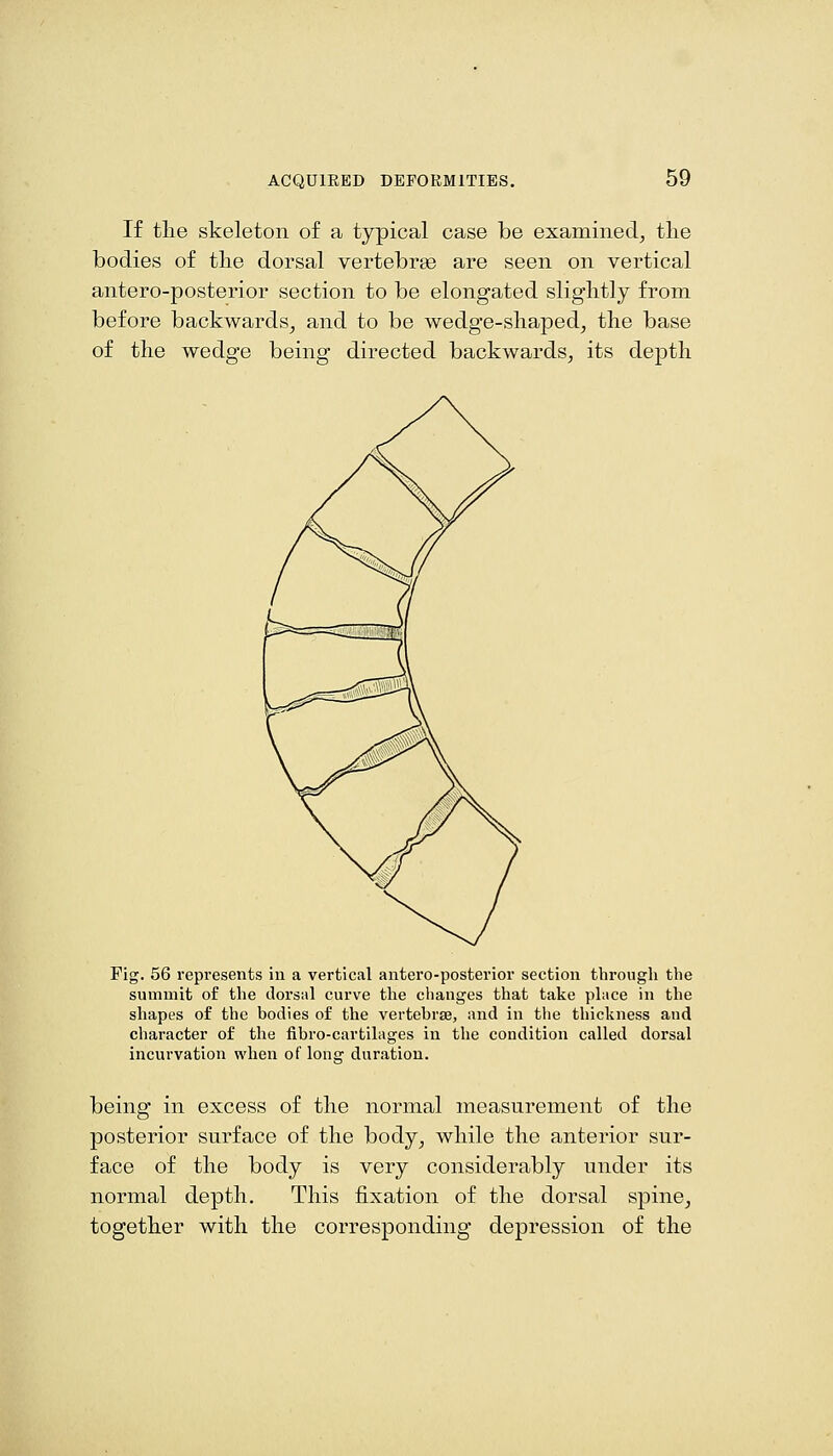 If tlie skeleton of a typical case be examined^ tlie bodies of tbe dorsal vertebrae are seen on vertical antero-posterior section to be elongated slightly from before backwards^ and to be wedge-shaped, the base of the wedge being directed backwards, its depth Pig. 56 represents in a vertical antero-posterior section through the summit of the dorsal curve the changes that take place in the shapes of the bodies of the vertebrae, and in the thickness and character of tlie fibro-cartilages in the condition called dorsal incurvation when of long duration. being in excess of the normal measurement of the posterior surface of the body, while the anterior sur- face of the body is very considerably under its normal depth. This fixation of the dorsal spine, together with the corresponding depression of the