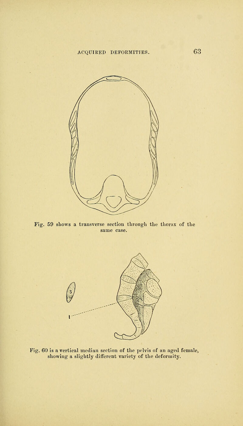 Fig. 59 shows a transverse section through the thornx of the same case. Fig. 60 is a vertical median section of the pelvis of an aged female, showing a slightly different variety of the deformity.