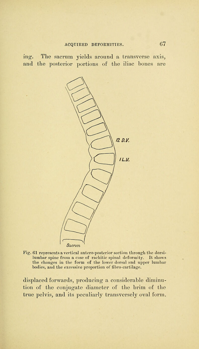 ing. The sacrum yields around a transverse axis, and the posterior portions of the iliac bones are 12 D.V. IL.y. Sacrum Fig. 61 represents a vertical autero-posterior section through the dorsi- lumbar spine from a cnse of rachitic spinal deformity. It shows the changes in tlie form of the lower dorsal and upper lumbar bodies, and the excessive proportion oF fibro-cartilage. displaced forwards, producing a considerable diminu- tion of the conjugate diameter of the brim of the true pelvis, and its peculiarly transversely oval form.