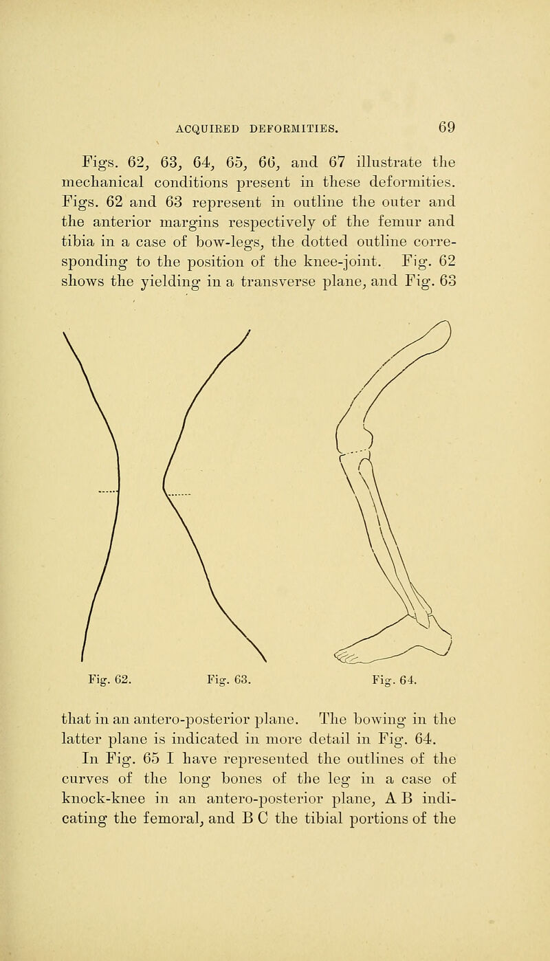 Figs. 62, 63, 64, 65, 66, and 67 illustrate the meclianical conditions present in tliese deformities. Figs. 62 and 63 represent in outline the outer and the anterior margins respectively of the femur and tibia in a case of bow-legs, the dotted outline corre- sponding to the position of the knee-joint. Fig. 62 shows the yielding in a transverse plane, and Fig. 63 Fig. 62. 63. Ficr. 64. that in an antero-posterior plane. The bowing in the latter plane is indicated in more detail in Fig. 64. In Fig. 65 I have represented the outlines of the curves of the long bones of the leg in a case of knock-knee in an antero-posterior plane, A B indi- cating the femoral, and B C the tibial portions of the