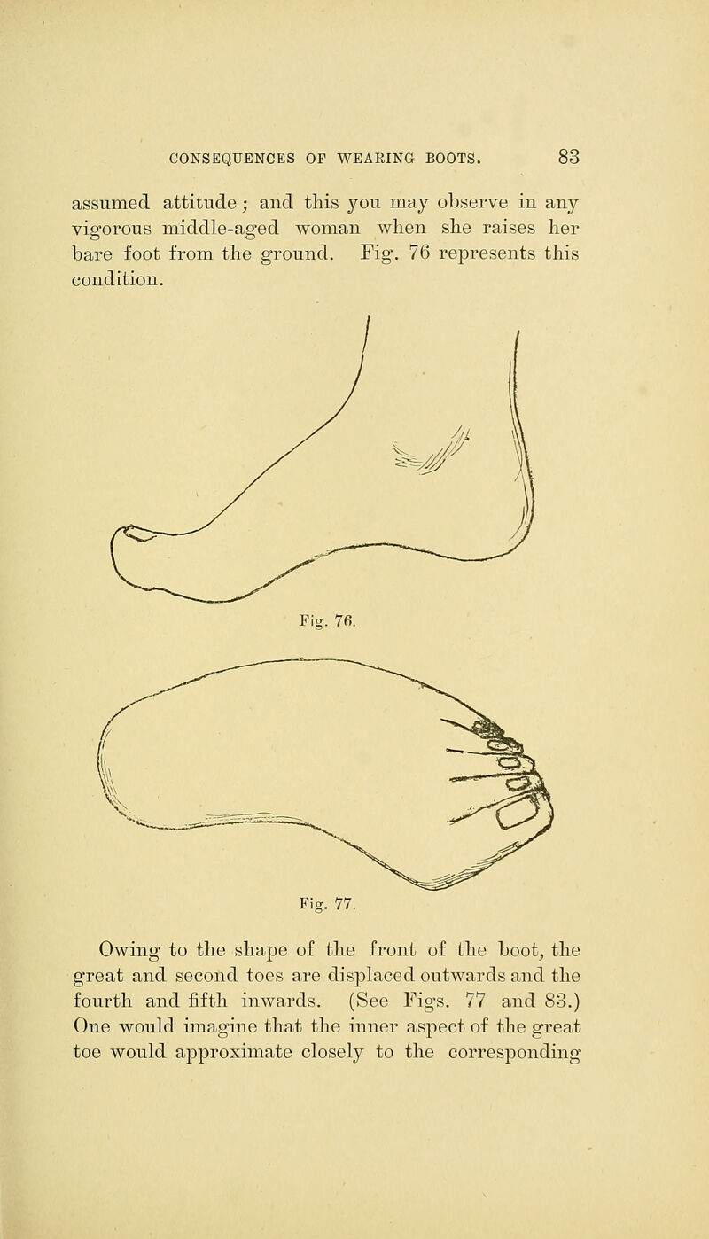 assumed attitude; and this you may observe in any vigorous middle-aged woman when she raises her bare foot from the ground. Fig. 76 represents this condition. Fig. 76. Fi^. 77. Owing to the shape of the front of the boot^ the great and second toes are displaced outwards and the fourth and fifth inwards. (See Figs. 77 and 83.) One would imagine that the inner aspect of the great toe would approximate closely to the corresponding
