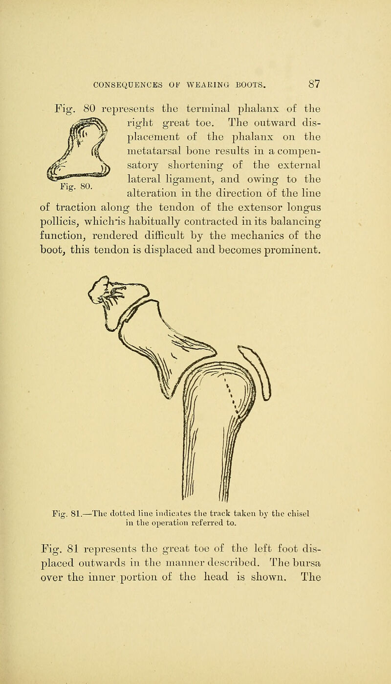 Fig. 80 represents the terminal phalanx of the right great toe. The outward dis- placement of the phalanx on the metatarsal bone results in a compen- satory shortening of the external lateral ligament, and owing to the Fig. 80. . °. . . ° alteration in the direction of the line of traction along the tendon of the extensor longus pollicis^ whichis habitually contracted in its balancing function^ rendered difl&cult by the mechanics of the boot, this tendon is displaced and becomes prominent. Fig. 81.—The dotted Hue indicates the track taken by the chisel in the operation referred to. Fig. 81 represents the great toe of the left foot dis- placed outwards in the manner described. The bursa over the inner, portion of the head is shown. The