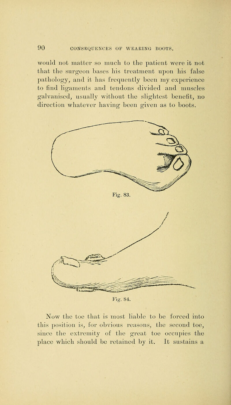 would not matter so mucli to tlie patient were it not that the surgeon bases his treatment upon his false pathology^ and it has frequently been my experience to find ligaments and tendons divided and muscles galvanised^ usually without the slightest benefit^ no direction whatever having been given as to boots. Fig. 83. Fig. 84. Now the toe that is most liable to be forced into this position is, for obvious reasons, the second toe, since the extremity of the great toe occupies the place which should be retained by it. It sustains a