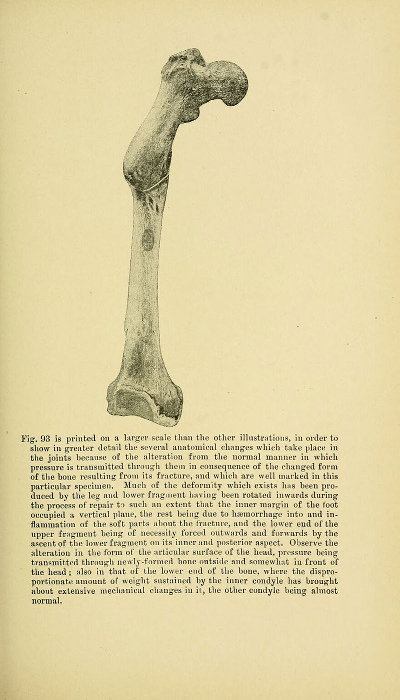 ■^•^■J^ ■■V4i>^ Fig. 93 is printed on a larger scale tlian the other illustrations, in order to show in greater detail the several anatomical changes which take place in the joints because of the alteration from the normal manner in which pressure is transmitted through them in consequence of the changed form of the bone resulting from its fracture, and which are well marked in this particular specimen. Much of the deformity which exists has been pro- duced by the leg and lower fragment having been rotated inwards during the process of repair to such an extent that the inner margin of the foot occupied a vertical plane, the rest being due to hsemorrhage into and in- flammation of the soft parts about the fracture, and the lower end of the upper fragment being of necessity forced outwards and forwards by the ascent of the lower fragment on its inner and posterior aspect. Observe the alteration in the form of the articular surface of the head, pressure being transmitted through newly-formed bone outside and somewhat in front of the head; also in that of the lower end of the bone, where the dispro- portionate amount of weight sustained by the inner condyle has brought about extensive mechanical changes in it, the other condyle being almost normal.