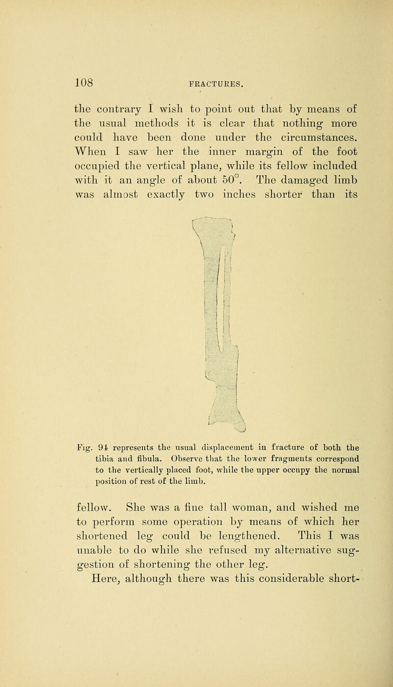 the contrary I wish to point out that by means of the usual methods it is clear that nothing more could have been done under the circumstances. When I saw her the inner margin of the foot occupied the vertical plane, while its fellow included with it an angle of about 50°. The damaged limb was almost exactly two inches shorter than its Fig. 91 represents the usual displacement in fracture of both the tibia and fibula. Observe that the lower fragments correspond to the vertically placed foot, while the upper occupy the normal position of rest of the limb. fellow. She was a fine tall woman, and wished me to perform some operation by means of which her shortened leg could be lengthened. This I was unable to do while she refused my alternative sug- gestion of shortening the other leg. Here^ although there was this considerable short-