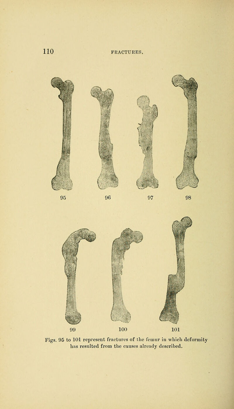 95 96 97 i 100 101 Figs. 95 to 101 represent fractures of the femur in which deformity has resulted from the causes already described.