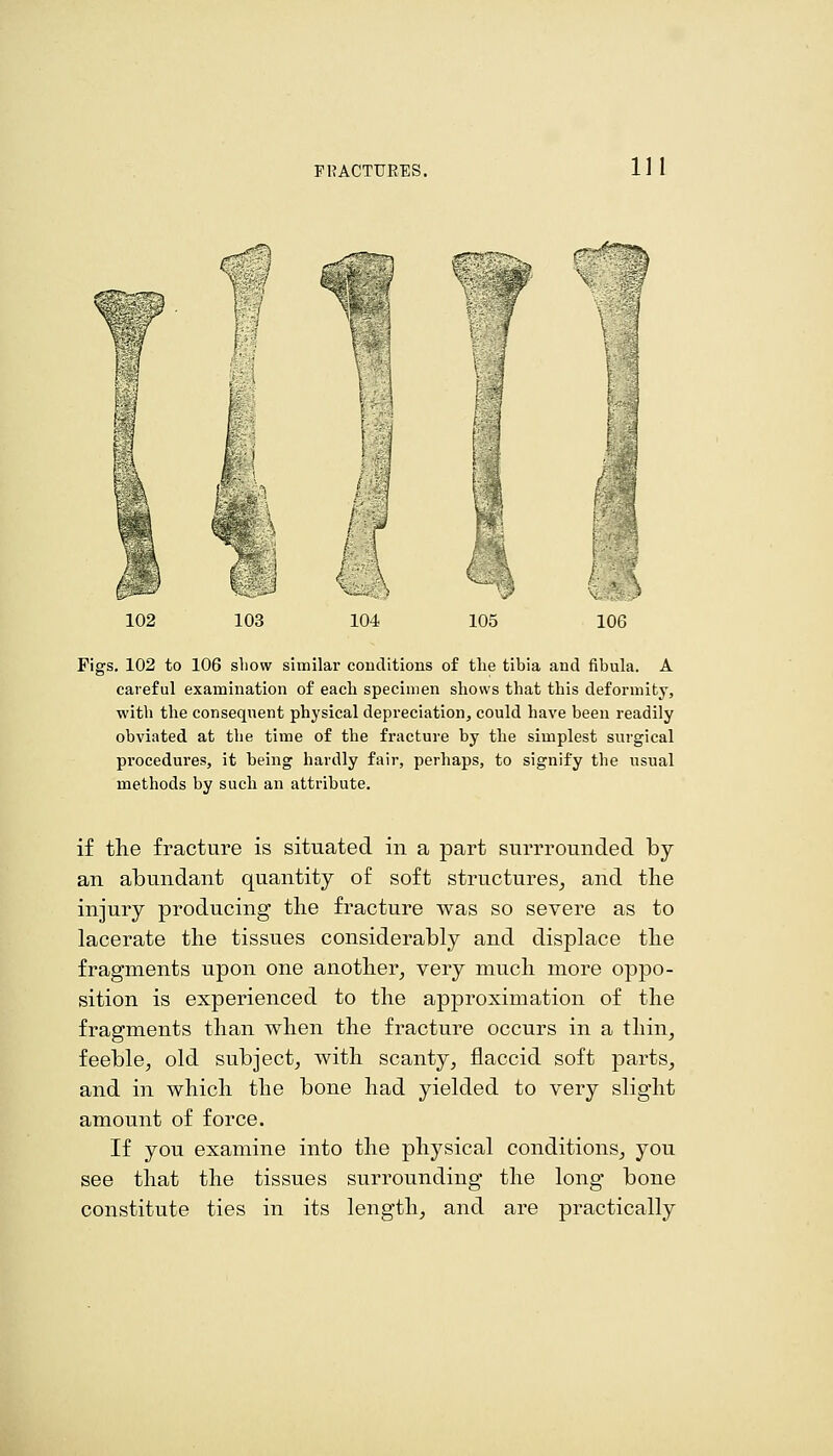 102 104 Figs. 102 to 106 show similar conditions of the tibia and fibula. A careful examination of eacli specimen shows that this deformity, with the consequent physical depreciation, could have been readily obviated at the time of the fracture by the simplest surgical procedures, it being hardly fair, perhaps, to signify the usual methods by such an attribute. if the fracture is situated in a part surrrounded by an abundant quantity of soft structures_, and the injury producing the fracture was so severe as to lacerate the tissues considerably and displace the fragments upon one another^ very much more oppo- sition is experienced to the approximation of the fragments than when the fracture occurs in a thin, feeble, old subject, with scanty, flaccid soft parts, and in which the bone had yielded to very slight amount of force. If you examine into the physical conditions, you see that the tissues surrounding the long bone constitute ties in its length, and are practically