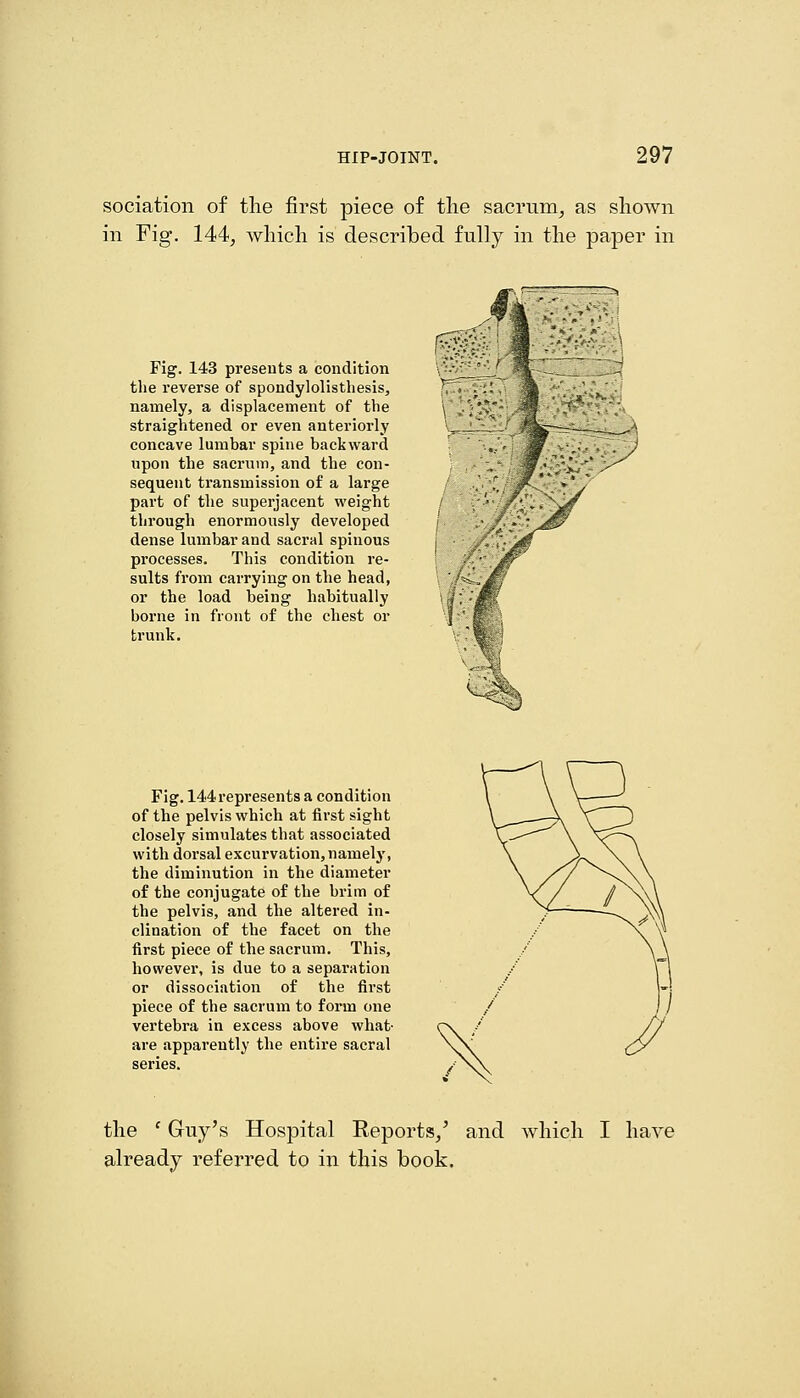 sociation of tlie first piece of the sacrum^ as sliown in Fig. 144, wliicli is described fully in the paper in Fig. 143 presents a condition the reverse of spondylolisthesis, namely, a displacement of the straightened or even anteriorly concave lumbar spine backward upon the sacrum, and the con- sequent transmission of a large part of the superjacent weight through enormously developed dense lumbar and sacral spinous processes. This condition re- sults from carrying on the head, or the load being habitually borne in front of the chest or trunk. Fig. 144represents a condition of the pelvis which at fii'st sight closely simulates that associated with dorsal excurvation,namely, the diminution in the diameter of the conjugate of the brim of the pelvis, and the altered in- clination of the facet on the first piece of the sacrum. This, however, is due to a separation or dissociation of the first piece of the sacrum to form one vertebra in excess above what- are apparently the entire sacral series. the ' Guy's Hospital Reports/ and which I have already referred to in this book.