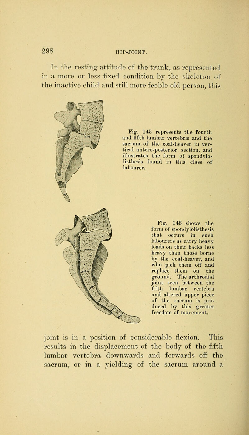 Tn the resting attitude of the trunk^ as represented in a more or less fixed condition by the skeleton of the inactive child and still more feeble old person, this Fig. 145 represents tlie fourth and fifth lumbar vertebrae and the sacrum of the coal-heaver in ver- tical antero-posterior section, and illustrates the form of spondylo- listhesis found in this class of labourer. Fig. 146 shows the form of spondylolisthesis that occurs in such labourers as carry heavy loads on their backs less heavy than those borne by the coal-heavei, and who pick them off and replace them on the ground. The arthrodial joint seen between the fifth lumbnr vertebra and altered upper piece of the sacrum is pro- duced by this greater freedom of movement. joint is in a position of considerable flexion. This results in the displacement of the body of the fifth lumbar vertebra downwards and forwards off the sacrum, or in a yielding of the sacrum around a