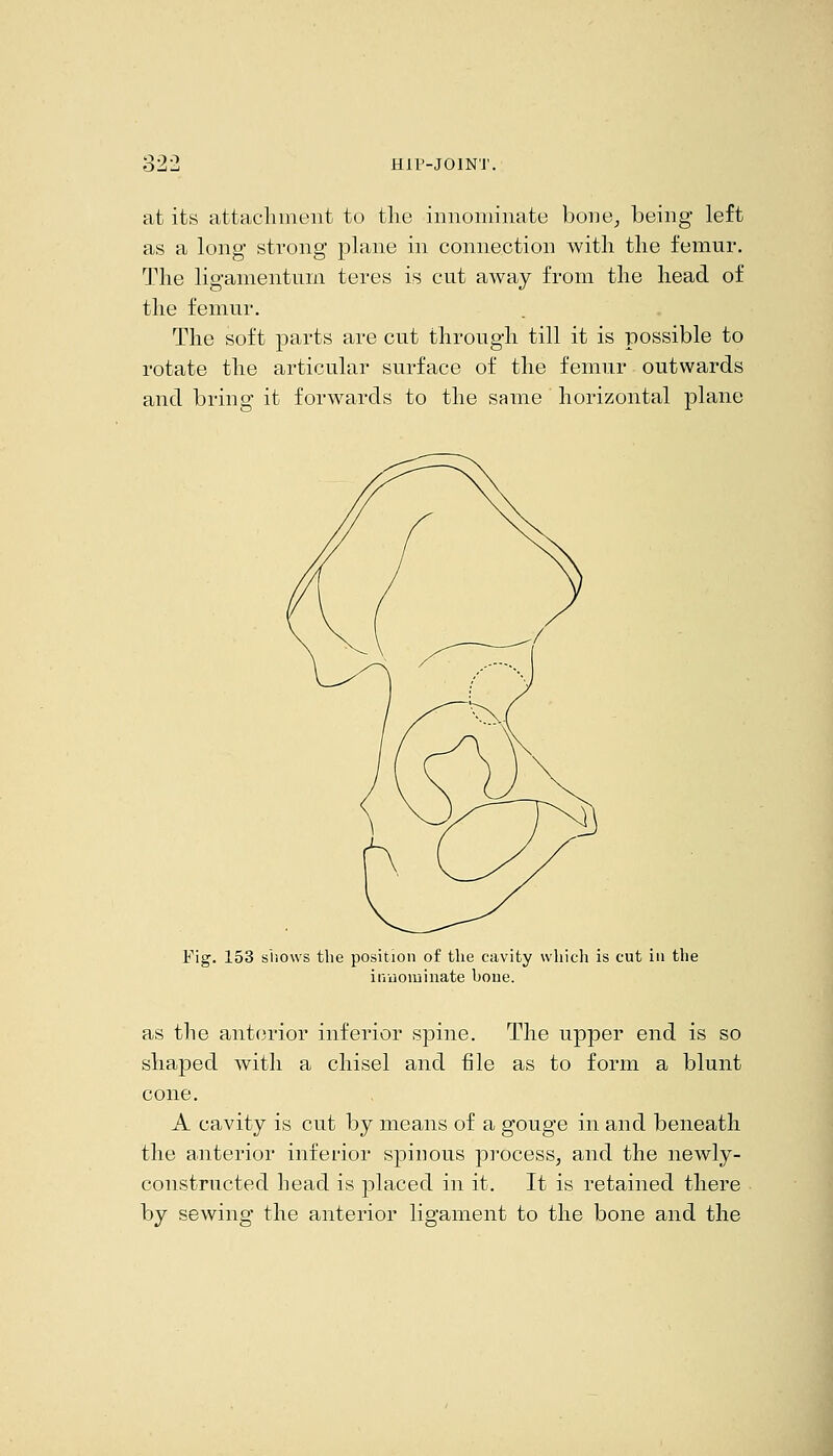 at its attachment to the innoniiiiate boiie^ being left as a long strong plane in connection with the femur. The ligamentum teres is cut away from the head of the femur. The soft parts are cut through till it is possible to rotate the articular surface of the femur outwards and bring it forwards to the same horizontal plane Fig. 153 s'liows the position of the cavity which is cut in the iI'lu0111 iliate boue. as the anterior inferior spine. The upper end is so shaped with a chisel and file as to form a blunt cone. A cavity is cut by means of a gouge in and beneath the anterior inferior spinous process, and the newly- constructed head is placed in it. It is retained there by sewing the anterior ligament to the bone and the