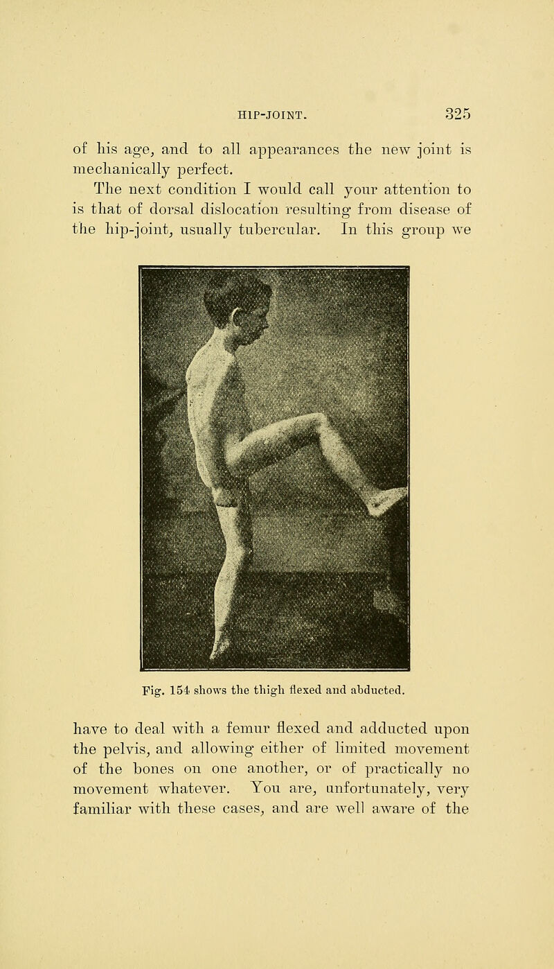 of liis age, and to all appearances tlie new joint is meclianically perfect. The next condition I would call your attention to is that of dorsal dislocation resulting from disease of the hip-joint^ usually tubercular. In this group we Fig. 154 shows the thigh flexed and abducted. have to deal with a femur flexed and adducted upon the pelvis, and allowing either of limited movement of the bones on one another, or of practicall}'- no movement whatever. You are, anfortunately, very familiar with these cases, and are well aware of the