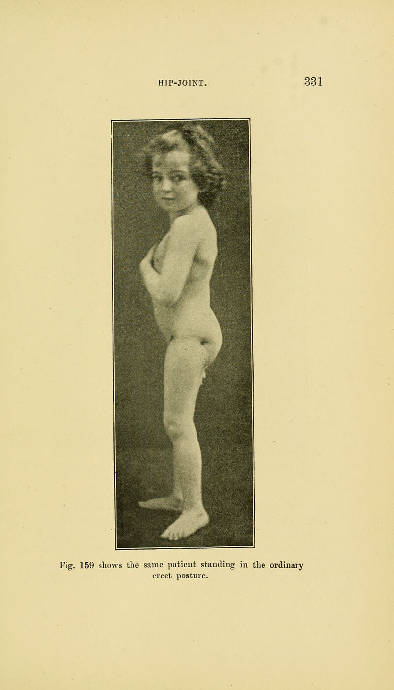 Fig. 159 shows the same patient standing in the ordinary erect posture.