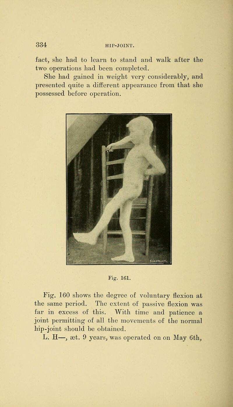 fact, she had. to learn to stand and walk after the two operations had. been completed. She had gained in weight very considerably, and presented quite a different appearance from that she possessed before operation. Fig. 161. Fig. 160 shows the degree of voluntary jflexion at the same period. The extent of passive flexion was far in excess of this. With time and patience a joint permitting of all the movements of the normal hip-joint should be obtained. L. H—, get. 9 years, was operated on on May 6th,