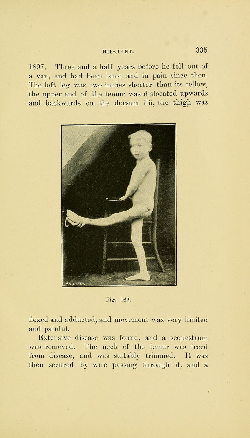 1897. Three and a lialf years before lie fell out of a van^ and had been lame and in pain since then. The left leg was two inches shorter than its fellow, the upper end of the femur was dislocated upwards and backwards on the dorsum ilii^, the thigh was Fig. 162. flexed and adducted, and movement was very limited and painful. Extensive disease was found, and a sequestrum was removed. The neck of the femur was freed from disease, and was suitably trimmed. It was then secured by wire passing through it, and a