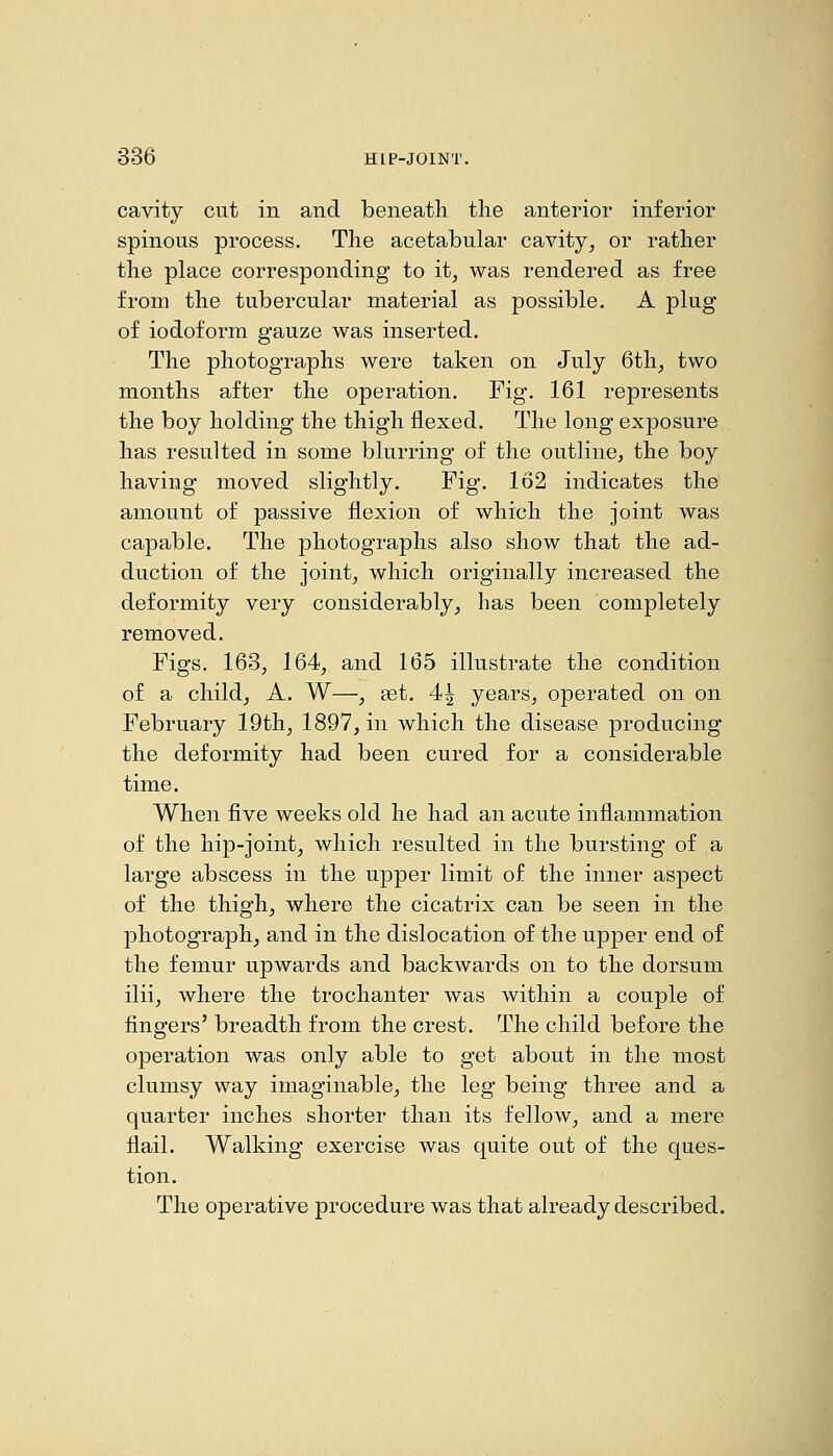 cavity cut in and beneatli the anterior inferior spinous process. The acetabular cavity, or rather the place corresponding to it, was rendered as free from the tubercular material as possible. A plug of iodoform gauze was inserted. The photographs were taken on July 6th, two months after the operation. Fig. 161 represents the boy holding the thigh flexed. The long exposure has resulted in some blurring of the outline, the boy having moved slightly. Fig. 162 indicates the amount of passive flexion of which the joint was capable. The photographs also show that the ad- duction of the joint, which originally increased the deformity very considerably, has been completely removed. Figs. 163, 164, and 165 illustrate the condition of a child, A. W—, set. 4^ years, operated on on February 19th, 1897, in which the disease producing the deformity had been cured for a considerable time. When five weeks old he had an acute inflammation of the hip-joint, which resulted in the bursting of a large abscess in the upper limit of the inner aspect of the thigh, where the cicatrix can be seen in the photograph, and in the dislocation of the upper end of the femur upwards and backwards on to the dorsum ilii, where the trochanter was within a couple of fingers' breadth from the crest. The child before the operation was only able to get about in the most clumsy way imaginable, the leg being three and a quarter inches shorter than its fellow, and a mere flail. Walking exercise was quite out of the ques- tion. The operative procedure was that already described.