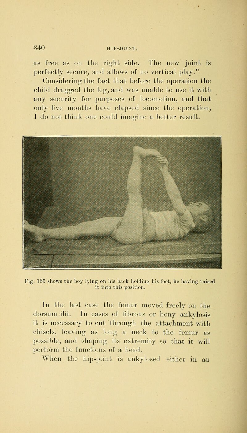as free as on the right side. The new joint is perfectly secure^ and allows of no vertical play. Considering the fact that before the operation the child dragged the leg, and was unable to use it with any security for purposes of locomotion, and that only five months have elapsed since the operation, I do not think one could imaaine a better result. Fig. 165 shows the hoy lyiug on his hack holding his foot, lie having raised it into this position. In the last case the femur moved freely on the dorsum ilii. In cases of fibrous or bony ankylosis it is necessary to cut through the attachment with chisels, leaving as long a neck to the femur as possible, and shaping its extremity so that it will perform the functions of a head. When the hip-joint is ankylosed either in an