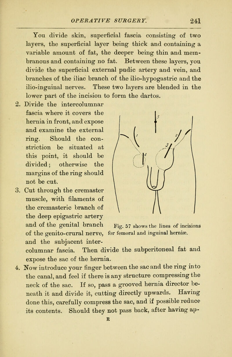 You divide skin, superficial fascia consisting of two layers, the superficial layer being thick and containing a variable amount of fat, the deeper being thin and mem- branous and containing no fat. Between these layers, you divide the superficial external pudic artery and vein, and branches of the iliac branch of the ilio-hypogastric and the ilio-inguinal nerves. These two layers are blended in the lower part of the incision to form the dartos. 2. Divide the intercolumnar fascia where it covers the hernia in front, and expose and examine the external ring. Should the con- striction be situated at this point, it should be divided; otherwise the margins of the ring should not be cut. 3. Cut through the cremaster muscle, with filaments of the cremasteric branch of the deep epigastric artery and of the genital branch ^ig. 57 shows the lines of incisions of the genito-crural nerve, for femoral and inguinal hernise. and the subjacent inter- columnar fascia. Then divide the subperitoneal fat and expose the sac of the hernia. 4. Now introduce your finger between the sac and the ring into the canal, and feel if there is any structure compressing the neck of the sac. If so, pass a grooved hernia director be- neath it and divide it, cutting directly upwards. Having done this, carefully compress the sac, and if possible reduce its contents. Should they not pass back, after having ap- R