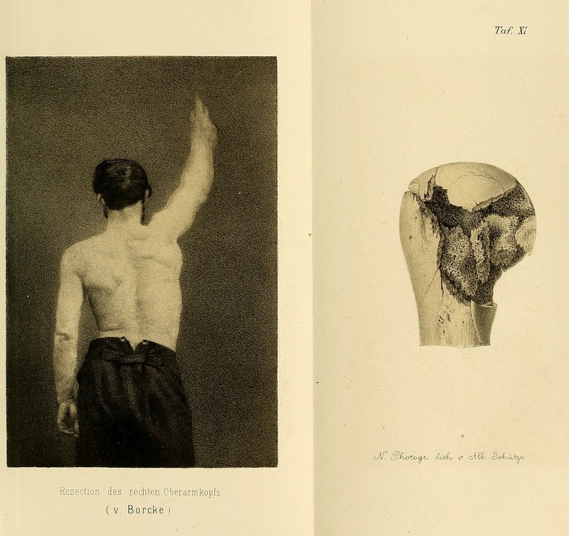 Taf. XL Resectioü des rexhten Oberarmkopfs, ( V, Borcke ) I lM. O^noto-aA/. Xvfevv v cXCfe. öwiaUä*' ■