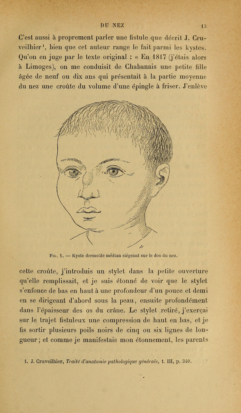 C'est aussi à proprement parler une fistule que décrit J. Cru- veilhier\ bien que cet auteur range le fait parmi les kystes. Qu'on en juge par le texte original : « En 1817 (j'étais alors à Limoges), on me conduisit de Chabanais une petite fille âgée de neuf ou dix ans qui présentait à la partie moyenne du nez une croûte du volume d'une épingle à friser. J'enlève FiG. 1. — Kyste dermoïde médian siégeant sur le dos du nez. cette croûte, j'introduis un stylet dans la petite ouverture qu'elle remplissait, et je suis étonné de voir que le stylet s'enfonce de bas en haut à une profondeur d'un pouce et demi en se dirigeant d'abord sous la peau, ensuite profondément dans l'épaisseur des os du crâne. Le stylet retiré, j'exerçai sur le trajet fistuleux une compression de haut en bas, et je fis sortir plusieurs poils noirs de cinq ou six lignes de lon- gueur ; et comme je manifestais mon étonnement, les parents 1. J. Graveilhier, Traité d'anatomie pathologique générale, t. III, p. 340.