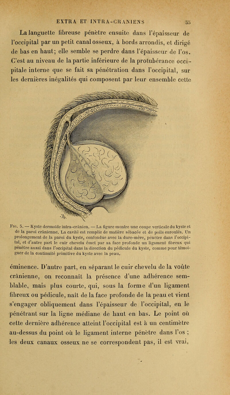 La languette fibreuse pénètre ensuite dans l'épaisseur de l'occipital par un petit canal osseux, à bords arrondis, et dirigé de bas en haut; elle semble se perdre dans l'épaisseur de Fos. C'est au niveau de la partie inférieure de la protubérance occi- pitale interne que se fait sa pénétration dans l'occipital, sur les dernières inégalités qui composent par leur ensemble cette FiG. 5. — Kyste dermoïde intra-crânien. — La figure montre une coupe verticale du kyste et de la paroi crânienne. La cavité est remplie de matière sébacée et de poils enroulés. Un prolongement de la paroi du kyste, confondue avec la dure-mère, pénètre dans l'occipi- tal, et d'autre part le cuir chevelu émet par sa face profonde un ligament fibreux qui pénètre aussi dans l'occipital dans la direction du pédicule du kyste, comme pour témoi- gner de la continuité primitive du kyste avec la peau. éminence. D'autre part, en séparant le cuir chevelu de la voûte crânienne, on reconnaît la présence d'une adhérence sem- blable, mais plus courte, qai, sous la forme d'un ligament fibreux ou pédicule, naît de la face profonde de la peau et vient s'engager obliquement dans l'épaisseur de l'occipital, en le pénétrant sur la ligne médiane de haut en bas. Le point oii cette dernière adhérence atteint l'occipital est à un centimètre au-dessus du point où le ligament interne pénètre dans l'os ; les deux canaux osseux ne se correspondent pas, il est vrai,