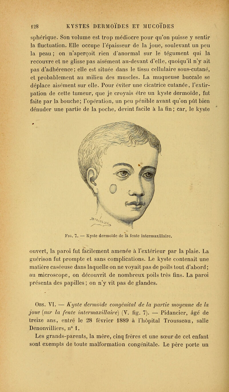 sphérique. Son volume est trop médiocre pour qu'on puisse y sentir la fluctuation. Elle occupe l'épaisseur de la joue, soulevant un peu la peau ; on n'aperçoit rien d'anormal sur le tégument qui la recouvre et ne glisse pas aisément au-devant d'elle, quoiqu'il n'y ait pas d'adhérence ; elle est située dans le tissu cellulaire sous-cutané, et probablement au milieu des muscles. La muqueuse buccale se déplace aisément sur elle. Pour éviter une cicatrice cutanée, l'extir- pation de cette tumeur, que je croyais être un kyste dermoïde, fut faite par la bouche; l'opération, un peu pénible avant qu'on pût bien dénuder une partie de la poche, devint facile à la fin; car, le kyste FiG. 7. — Kyste dermoïde de la fente interraaxillaire. ouvert, la paroi fut facilement amenée à l'extérieur par la plaie, La guérison fut prompte et sans complications. Le kyste contenait une matière caséeuse dans laquelle on ne voyait pas de poils tout d'abord ; au microscope, on découvrit de nombreux poils très fins. La paroi présenta des papilles ; on n'y vit pas de glandes. Obs. VI. — Kyste dermoïde congénital de la partie moyenne de la joue {sur la fente intermaxillaire) (V. fig. 7). — Pidancier, âgé de treize ans, entré le 28 février 1889 à l'hôpital Trousseau, salle Denonvilliers, n° 1. Les grands-parents, la mère, cinq frères et une sœur de cet enfant sont exempts de toute malformation congénitale. Le père porte un