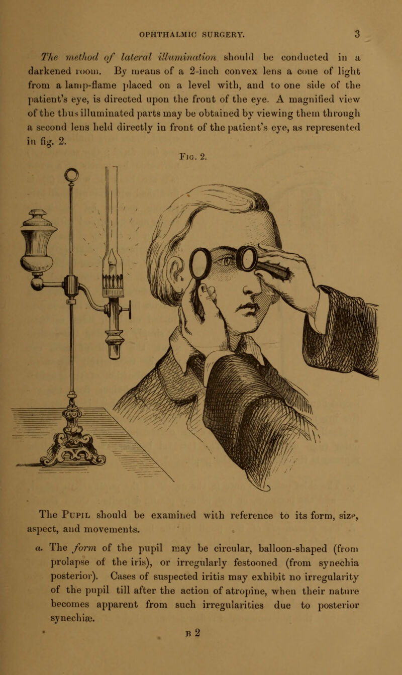 The method of lateral illumination should be conducted in a darkened room. By means of a 2-inch convex lens a cone of light from a lamp-flame placed on a level with, and to one side of the patient's eye, is directed upon the front of the eye. A magnified view of the thus illuminated parts may be obtained by viewing them through a second lens held directly in front of the patient's eye, as represented in fig. 2. Fig. 2. The Pupil should be examined with reference to its form, siz^, aspect, and movements. a. The form of the pupil may be circular, balloon-shaped (from prolapse of the iris), or irregularly festooned (from synechia posterior). Cases of suspected iritis may exhibit no irregularity of the pupil till after the action of atropine, when their nature becomes apparent from such irregularities due to posterior synechise. b2