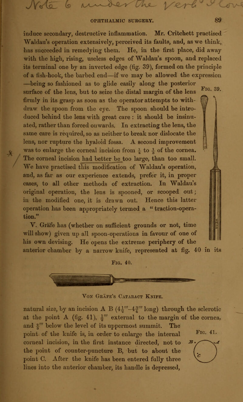 JY<AsL to nA^-a^f'vhj- y*sr& ** OPHTHALMIC SURGERY. 80 induce secondary, destructive inflammation. Mr. Critchett practised Waldau's operation extensively, perceived its faults, and, as we think, has succeeded in remedying them. He, in the first place, did away with the high, rising, useless edges of Waldau's spoon, and replaced its terminal one by an inverted edge (fig. 39), formed on the principle of a fish-hook, the barbed end—if we may be allowed the expression —being so fashioned as to glide easily along the posterior surface of the lens, but to seize the distal margin of the lens firmly in its grasp as soon as the operator attempts to with- draw the spoon from the eye. The spoon should be intro- duced behind the lens with great care : it should be insinu- ated, rather than forced onwards. In extracting the lens, the same care is required, so as neither to break nor dislocate the lens, nor rupture the hyaloid fossa. A second improvement was to enlarge the corneal incision from ito| of the cornea. The corneal incision had better_be_too large, than too small. We have practised this modification of Waldau's operation, and, as far as our experience extends, prefer it, in proper cases, to all other methods of extraction. In Waldau's original operation, the lens is spooned, or scooped out; in the modified one, it is drawn out. Hence this latter operation has been appropriately termed a  traction-opera- tion. V. Grafe has (whether on sufficient grounds or not, time will show) given up all spoon-operations in favour of one of his own devising. He opens the extreme periphery of the anterior chamber by a narrow knife, represented at fig. 40 in its Fig. 40. Vox Grafe's Cataract Knife. Fig. 41. natural size, by an incision A B (4^ -4f' long) through the sclerotic at the point A (fig. 41), i' external to the margin of the cornea, and |-' below the level of its uppermost summit. The point, of the knife is, in order to enlarge the internal corneal incision, in the first instance directed, not to the point of counter-puncture B, but to about the point C. After the knife has been entered fully three lines into the anterior chamber, its handle is depressed,