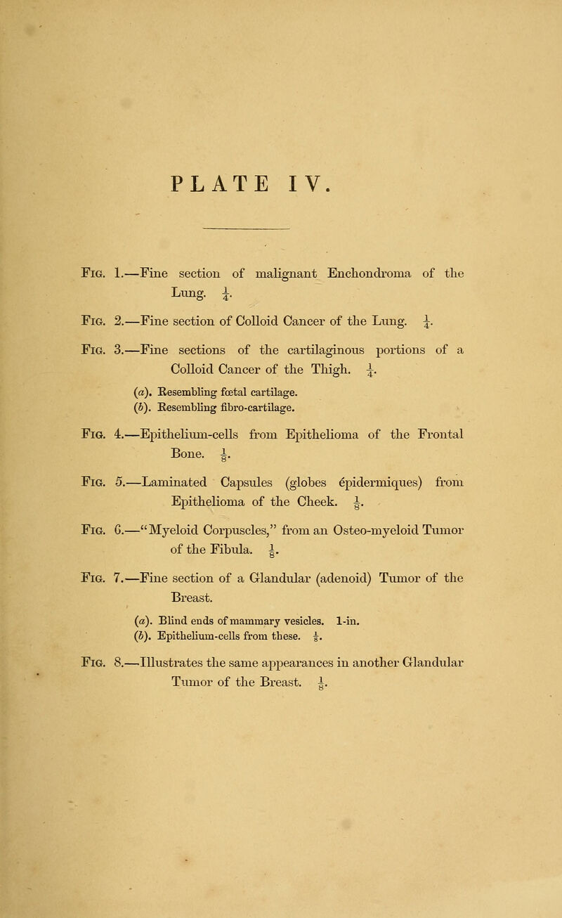 PLATE IV. Fig. 1.—Fine section of malignant Enchondroma of the Lung. i. Fig. 2.—Fine section of Colloid Cancer of the Lung. ^. Fig. 3.—Fine sections of the cartilaginous portions of a Colloid Cancer of the Thigh. ^. (a). Resembling fcetal cartilage. (6). Eesembling fibro-cartilage. Fig. 4.—Ej)itheliuni-cells from Epithelioma of the Frontal Bone. 1. Fig. 5.—Laminated Capsules (globes ^pidermiques) from Epithelioma of the Cheek, i. Fig. G.—Myeloid Corpuscles, from an Osteo-myeloid Tumor of the Fibula, i. Fig. 7.—Fine section of a Glandular (adenoid) Tumor of the Breast. (a). Blind ends of mammary vesicles. 1-in, (b). Epithelium-cells from these. |. Fig. 8.—Illustrates the same appearances in another Glandular Tumor of the Breast, i.