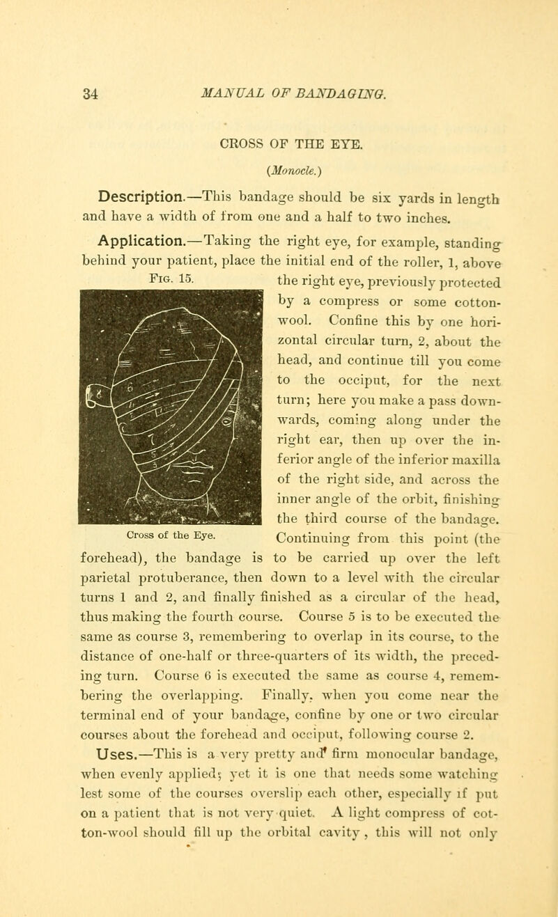 CROSS OF THE EYE. {Monocle.) Description.—This bandage should be six yards in length and have a width of from one and a half to two inches. Application.—Taking the right eye, for example, standing behind your patient, place the initial end of the roller, 1, above FlG- 15- the right eye, previously protected by a compress or some cotton- wool. Confine this by one hori- zontal circular turn, 2, about the head, and continue till you come to the occiput, for the next turn; here you make a pass down- wards, coming along under the right ear, then up over the in- ferior angle of the inferior maxilla of the right side, and across the inner angle of the orbit, finishing the third course of the bandage. Cross of the Eye. Continuing from this point (the forehead), the bandage is to be carried up over the left parietal protuberance, then down to a level with the circular turns 1 and 2, and finally finished as a circular of the head, thus making the fourth course. Course 5 is to be executed the same as course 3, remembering to overlap in its course, to the distance of one-half or three-quarters of its width, the preced- ing turn. Course 6 is executed the same as course 4, remem- bering the overlapping. Finally, when you come near the terminal end of your bandage, confine by one or two circular courses about the forehead and occiput, following course 2. Uses.—This is a very pretty and* firm monocular bandage, when evenly applied; yet it is one that needs some watehiiiLT lest some of the courses overslip each other, especially if put on a patient that is not very quiet. A light compress of cot- ton-wool should fill up the orbital cavity , this will not only