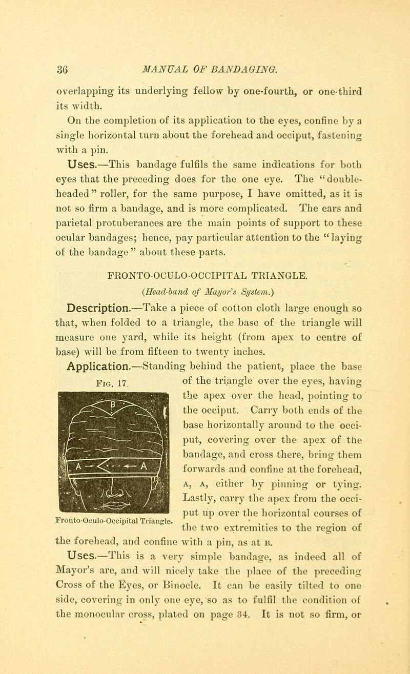 overlapping its underlying fellow by one-fourth, or one-third its width. On the completion of its application to the eyes, confine by a single horizontal turn about the forehead and occiput, fastening with a pin. Uses.—This bandage fulfils the same indications for both eyes that the preceding does for the one eye. The double- headed  roller, for the same purpose, I have omitted, as it is not so firm a bandage, and is more complicated. The ears and parietal protuberances are the main points of support to these ocular bandages; hence, pay particular attention to the  laying of the bandage  about these parts. FRONTO-OCULO-OCCIPITAL TRIANGLE. {Head-band of Mayor's System.) Description.—Take a piece of cotton cloth large enough so that, when folded to a triangle, the base of the triangle will measure one yard, while its height (from apex to centre of base) will be from fifteen to twenty inches. Application.—Standing behind the patient, place the base j?m% 17. of the triangle over the eyes, having the apex over the head, pointing to the occiput. Carry both ends of the base horizontally around to the occi- put, covering over the apex of the bandage, and cross there, bring them forwards and confine at the forehead, A. a, either by pinning or tying. Lastly, carry the apex from the occi- put up over the horizontal courses of Fronto-Oculo-Occipital Triangle. • . . . the two extremities to the region of the forehead, and confine with a pin, as at b. Uses.—This is a very simple bandage, as indeed all of Mayor's are, and will nicely take the place of the preceding Cross of the Eyes, or Binocle. It can be easily tilted to one side, covering in only one eye, so as to fulfil the condition of the monocular cross, plated on page 34. It is not so firm, or