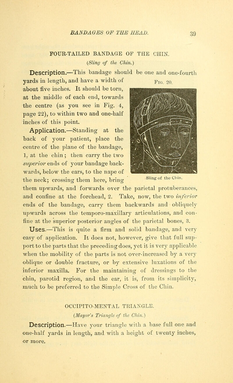 FOUR-TAILED BANDAGE OF THE CHIN. (Sling of the Chin.) Description.—This bandage should be one and one-fourth yards in length, and have a width of pIG 2o. about five inches. It should be torn, at the middle of each end, towards the centre (as you see in Fig. 4, page 22), to within two and one-half inches of this point. Application.—Standing at the back of your patient, place the centre of the plane of the bandage, 1, at the chin; then carry the two superior ends of your bandage back- wards, below the ears, to the nape of the neck; crossing them here, bring ' slingof theChhl- them upwards, and forwards over the parietal protuberances, and confine at the forehead, 2. Take, now, the two inferior ends of the bandage, carry them backwards and obliquely upwards across the temporo-maxillary articulations, and con- fine at the superior posterior angles of the parietal bones, 3. Uses.—This is quite a firm and solid bandage, and very easy of application. It does not, however, give that full sup- port to the parts that the preceding does, yet it is very applicable when the mobility of the parts is not over-increased by a very oblique or double fracture, or by extensive luxations of the inferior maxilla. For the maintaining of dressings to the chin, parotid region, and the ear, it is, from its simplicity, much to be preferred to the Simple Cross of the Chin. OCCIPITO-MENTAL TRIANGLE. (Mayor's Triangle of the Chin.) Description.—Have your triangle with a base full one and one-half yards in length, and with a height of twenty inches, or more.