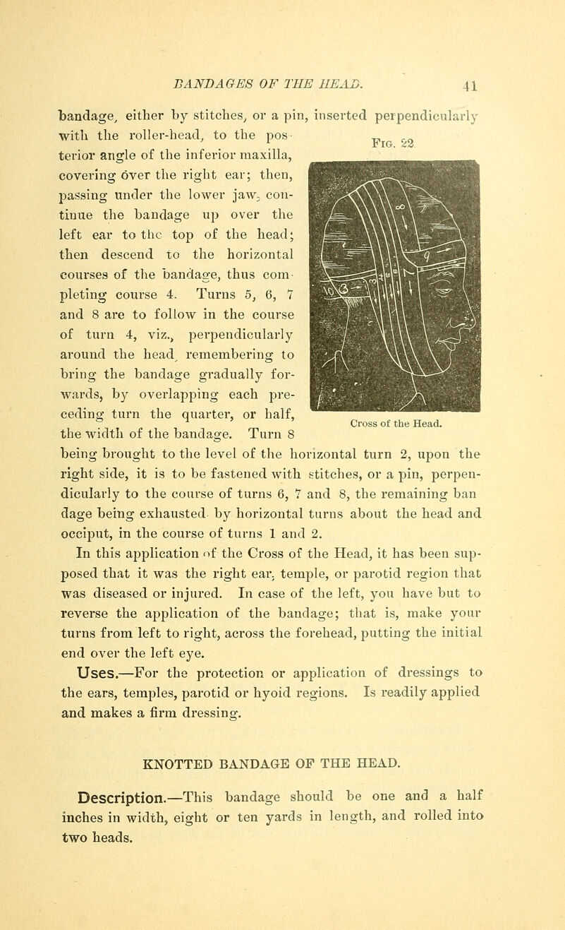 bandage, either by stitches, or a pin, inserted perpendicularly with the roller-head, to the pos „ terior angle of the inferior maxilla, covering over the right ear; then, passing under the lower jaw: con- tinue the bandage up over the left ear to the top of the head; then descend to the horizontal courses of the bandage, thus com- pleting course 4. Turns 5, 6, 7 and 8 are to follow in the course of turn 4, viz., perpendicularly around the head^ remembering to bring the bandage gradually for- wards, by overlapping each pre- ceding turn the quarter, or half, the width of the bandage. Turn 8 being brought to the level of the horizontal turn 2, upon the right side, it is to be fastened with stitches, or a pin, perpen- dicularly to the course of turns 6, 7 and 8, the remaining ban dage being exhausted by horizontal turns about the head and occiput, in the course of turns 1 and 2. In this application of the Cross of the Head, it has been sup- posed that it was the right eai\ temple, or parotid region that was diseased or injured. In case of the left, you have but to reverse the application of the bandage; that is, make your turns from left to right, across the forehead, putting the initial end over the left eye. Uses.—For the protection or application of dressings to the ears, temples, parotid or hyoid regions. Is readily applied and makes a firm dressing. Cross of the Head. KNOTTED BANDAGE OF THE HEAD. Description.—This bandage should be one and a half inches in width, eight or ten yards in length, and rolled into two heads.