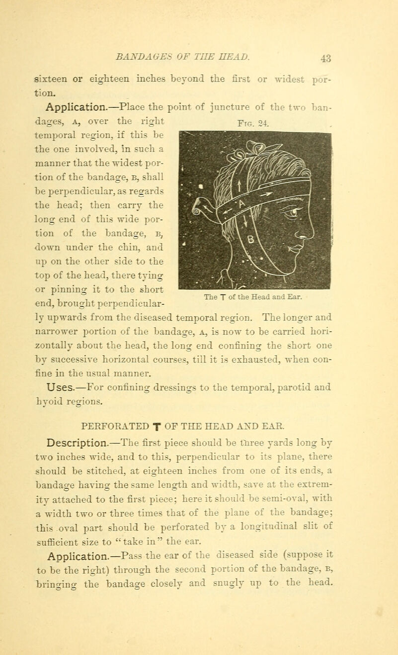 sixteen or eighteen inches beyond the first or widest por- tion. Application.—Place the point of juncture of the two ban- dages, A, over the right Yjg. 24. temporal region, if this be the one involved, in such a manner that the widest por- tion of the bandage, b, shall be perpendicular, as regards the head; then carry the long end of this wide por- tion of the bandage, b; down under the chin, and up on the other side to the top of the head, there tying or pinning it to the short end, brought perpendicular- ly upwards from the diseased temporal region. The longer and narrower portion of the bandage, a, is now to be carried hori- zontally about the head, the long end confining the short one by successive horizontal courses, till it is exhausted, when con- fine in the usual manner. Uses.—For confining dressings to the temporal, parotid and hvoid regions. The T of the Head and Ear. PERFORATED T OF THE HEAD AXD EAR. Description.—The first piece should be three yards long by two inches wide, and to this, perpendicular to its plane, there should be stitched, at eighteen inches from one of its ends, a bandage having the same length and width, save at the extrem- ity attached to the first piece; here it should be semi-oval, with a width two or three times that of the plane of the bandage; this oval part should be perforated by a longitudinal slit of sufficient size to  take in  the ear. Application.—Pass the ear of the diseased side (suppose it to be the right) through the second portion of the bandage, b, bringing the bandage closely and snugly up to the head.