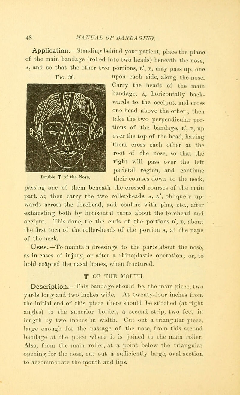 Application.—Standing behind your patient, place the plane of the main bandage (rolled into two heads) beneath the nose, a, and so that the other two portions, b', b, may pass up, one Fig. 30. upon each side, along the nose. Carry the heads of the main bandage, a, horizontally back- wards to the occiput, and cross one head above the other, then take the two perpendicular por- tions of the bandage, b', b, up over the top of the head, having them cross each other at the root of the nose, so that the right will pass over the left parietal region, and continue Double T of the Nose. tlieir courses down to the neck, passing one of them beneath the crossed courses of the main part, a; then carry the two roller-heads, a, a', obliquely up- wards across the forehead, and confine with pins, etc., after exhausting both by horizontal turns about the forehead and occiput. This done, tie the ends of the portions b', b, about the first turn of the roller-heads of the portion A, at the nape of the neck. Uses.—To maintain dressings to the parts about the nose, as in cases of injury, or after a rhinoplastic operation; or, to hold coapted the nasal bones, when fractured. T OF THE MOUTH. Description.—This bandage should be, the main piece, two yards long and two inches wide. At twenty-four inches from the initial end of this piece there should be stitched (at right angles) to the superior border, a second strip, two feet in length by two inches in width. Cut out a triangular piece, large enough for the passage of the nose, from this second bandage at the place where it is joined to the main roller. Also, from the main roller, at a point below the triangular opening for the nose, cut out a sufficiently large, oval section to accommodate the mouth and lips.