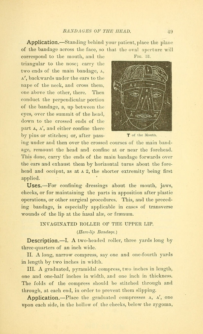 Application.—Standing behind your patient, place the plane of the bandage across the face, so that the oval aperture will correspond to the mouth, and the Fig. 31. triangular to the nose; carry the two ends of the main bandage, a, a', backwards under the ears to the nape of the neck, and cross them, one above the other, there. Then conduct the perpendicular portion of the bandage, b, up between the eyes, over the summit of the head, down to the crossed ends of the part A, a', and either confine there by pins or stitches; or, after pass- T of the Mouth. ing under and then over the crossed courses of the main band- age, remount the head and confine at or near the forehead. This done, carry the ends of the main bandage forwards over the ears and exhaust them by horizontal turns about the fore- head and occiput, as at a 2, the shorter extremity being first applied. Uses.—For confining dressings about the mouth, jaws, cheeks, or for maintaining the parts in apposition after plastic operations, or other surgical procedures. This, and the preced- ing bandage, is especially applicable in cases of transverse wounds of the lip at the nasal alae, or frsenum. INVAGINATED ROLLER OF THE UPPER LIP. {Hare-lip Bandage.) Description.—I. A two-headed roller, three yards long by three-quarters of an inch wide. II. A long, narrow compress, say one and one-fourth yards in length by two inches in width. III. A graduated, pyramidal compress, two inches in length, one and one-half inches in width, and one inch in thickness. The folds of the compress should be stitched through and through, at each end, in order to prevent them slipping. Application.—Place the graduated compresses a, a', one upon each side, in the hollow of the cheeks, below the zygoma,