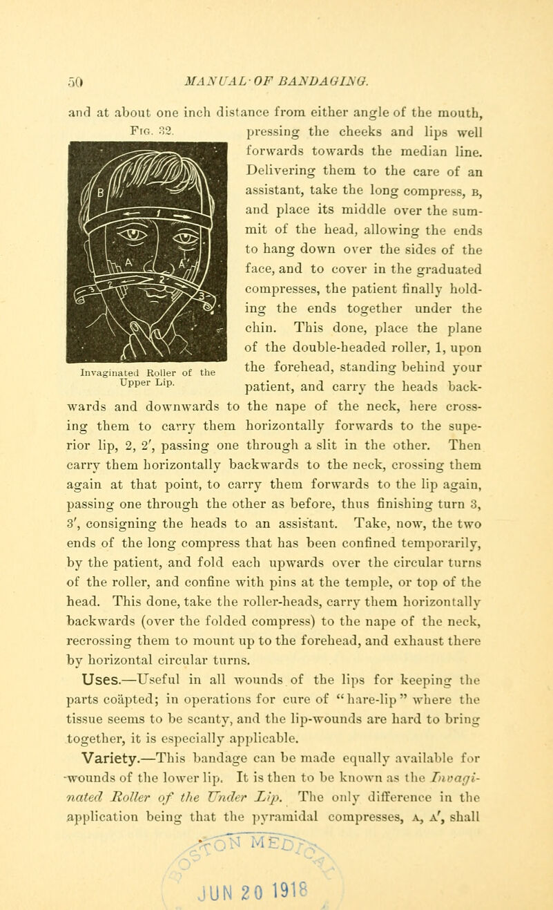 Invaginaled Roller of the Upper Lip. and at about one inch distance from either angle of the mouth, Fig. 32. pressing the cheeks and lips well forwards towards the median line. Delivering them to the care of an assistant, take the long compress, b, and place its middle over the sum- mit of the head, allowing the ends to hang down over the sides of the face, and to cover in the graduated compresses, the patient finally hold- ing the ends together under the chin. This done, place the plane of the double-headed roller, 1, upon the forehead, standing behind your patient, and carry the heads back- wards and downwards to the nape of the neck, here cross- ing them to carry them horizontally forwards to the supe- rior lip, 2, 2', passing one through a slit in the other. Then carry them horizontally backwards to the neck, crossing them again at that point, to carry them forwards to the lip again, passing one through the other as before, thus finishing turn 3, 3', consigning the heads to an assistant. Take, now, the two ends of the long compress that has been confined temporarily, by the patient, and fold each upwards over the circular turns of the roller, and confine with pins at the temple, or top of the head. This done, take the roller-heads, carry them horizontally backwards (over the folded compress) to the nape of the neck, recrossing them to mount up to the forehead, and exhaust there by horizontal circular turns. Uses.—Useful in all wounds of the lips for keeping the parts coapted; in operations for cure of hare-lip where the tissue seems to be scanty, and the lip-wounds are hard to bring together, it is especially applicable. Variety.—This bandage can be made equally available for •wounds of the lower lip. It is then to be known as the Tnvagi- nated Roller of the Under Lip. The only difference in the application being that the pyramidal compresses, a, a', shall * 1 Ml UN 20 191?
