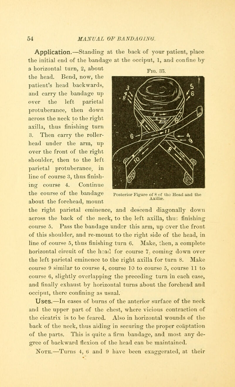 Posterior Figure of 8 of the Head and the Axillae. Application.—Standing at the back of your patient, place the initial end of the bandage at the occiput, 1, and confine by a horizontal turn, 2, about p, „g the head. Bend, now, the patient's head backwards, and carry the bandage up over the left parietal protuberance, then down across the neck to the right axilla, thus finishing turn 3. Then carry the roller- head under the arm, up over the front of the right shoulder, then to the left parietal protuberance, in line of course 3, thus finish- ing course 4. Continue the course of the bandage about the forehead, mount the right parietal eminence, and descend diagonally down across the back of the neck, to the left axilla, thus finishing course 5. Pass the bandage under this arm, up over the front of this shoulder, and re-mount to the right side of the head, in line of course 5, thus finishing turn 6. Make, then, a complete horizontal circuit of the hoad for course 7- coming down over the left parietal eminence to the right axilla for turn 8. Make- course 9 similar to course 4, course 10 to course 5, course 11 to course 6, slightly overlapping the preceding turn in each case, and finally exhaust by horizontal turns about the forehead and occiput, there confining as usual. Uses.—In cases of burns of the anterior surface of the neck and the upper part of the chest, where vicious contraction of the cicatrix is to be feared. Also in horizontal wounds of the back of the neck, thus aiding in securing the proper coaptation of the parts. This is quite a firm bandage, and most any de- gree of backward flexion of the head can be maintained. Note.—Turns 4, (3 and 9 have been exaggerated, at their