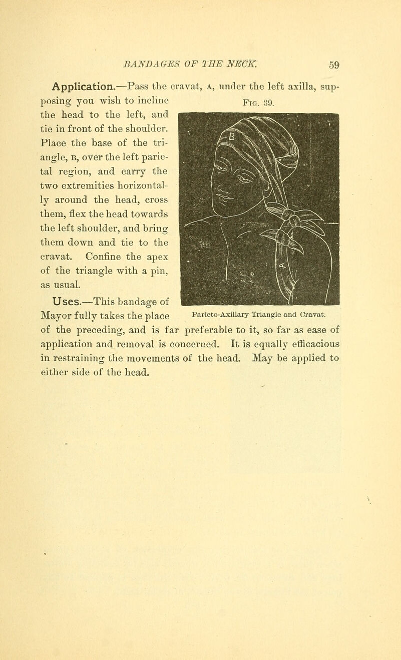 Application.—Pass the cravat, a, under the left axilla, sup- posing you wish to incline FTG. 09 the head to the left, and tie in front of the shoulder. Place the base of the tri- angle, b,- over the left parie- tal region, and carry the two extremities horizontal- ly around the head, cross them, flex the head towards the left shoulder, and bring them down and tie to the cravat. Confine the apex of the triangle with a pin, as usual. Uses.—This bandage of Mayor fully takes the place Parieto-Axillary Triangle and Cravat. of the preceding, and is far prefei'able to it, so far as ease of application and removal is concerned. It is equally efficacious in restraining the movements of the head. May be applied to either side of the head.