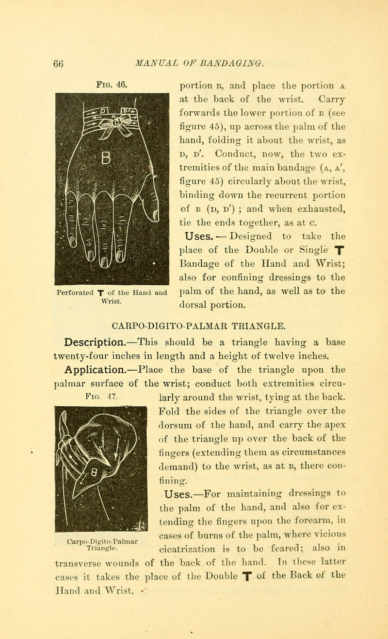 Fig. 46. Perforated T of the Hand and Wrist. portion b, and place the portion a at the back of the wrist. Carry- forwards the lower portion of B (see figure 45), up across the palm of the hand, folding it about the wrist, as d, d'. Conduct, now, the two ex- tremities of the main bandage (a, a', figure 45) circularly about the wri-t, binding down the recurrent portion of b (d, d') ; and when exhausted, tie the ends together, as at c. Uses. — Designed to take the place of the Double or Single T Bandage of the Hand and Wrist; also for confining dressings to the palm of the hand, as well as to the dorsal portion. CARPO-DIGITO-PALMAR TRIANGLE. Description.—This should be a triangle having a base twenty-four inches in length and a height of twelve inches. Application.—Place the base of the triangle upon the palmar surface of the wrist; conduct both extremities circu- Fig. 47. larly around the wrist, tying at the back. Fold the sides of the triangle over the dorsum of the hand, and carry the apex of the triangle up over the back of the fingers (extending them as circumstances demand) to the wrist, as at b, there con- fining. Uses.—For maintaining dressings to the palm of the hand, and also for ex- tending the fingers upon the forearm, in cases of burns of the palm, where virions cicatrization is to be feared: also in transverse wounds of the back, of the hand. In these latter cases it takes the place of the Double T oi tne Back oi the Hand and Wrist. • Carpo-Digito-Palmar Triangle.
